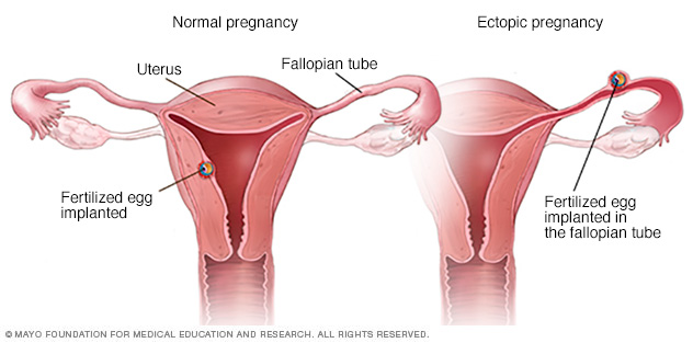 Progesterone Levels and Ectopic Pregnancy